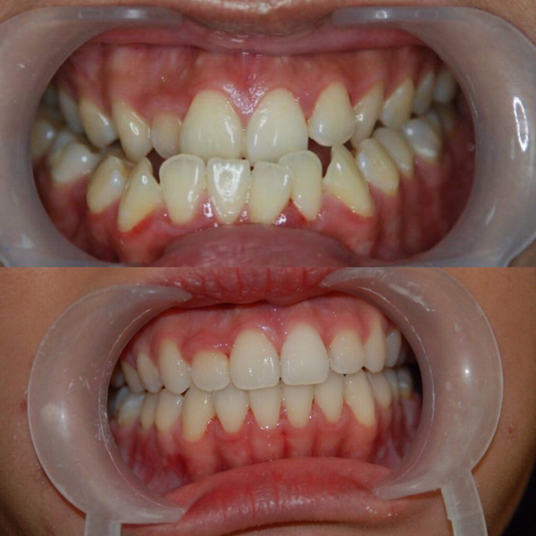 Trước và sau niềng răng với khớp cắn ngược