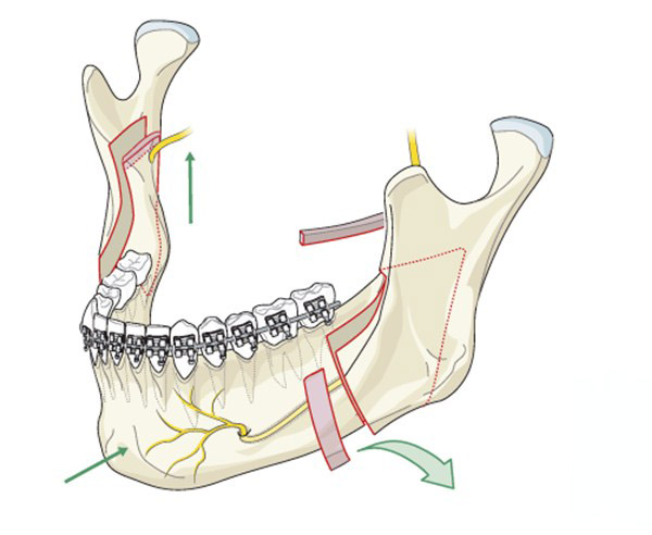 Phẫu thuật cắt xương hàm dưới kết hợp niềng răng với khớp cắn ngược do cả xương và răng
