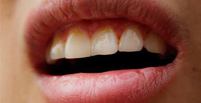 Khô miệng gây hôi miệng - Nha khoa Yteeth