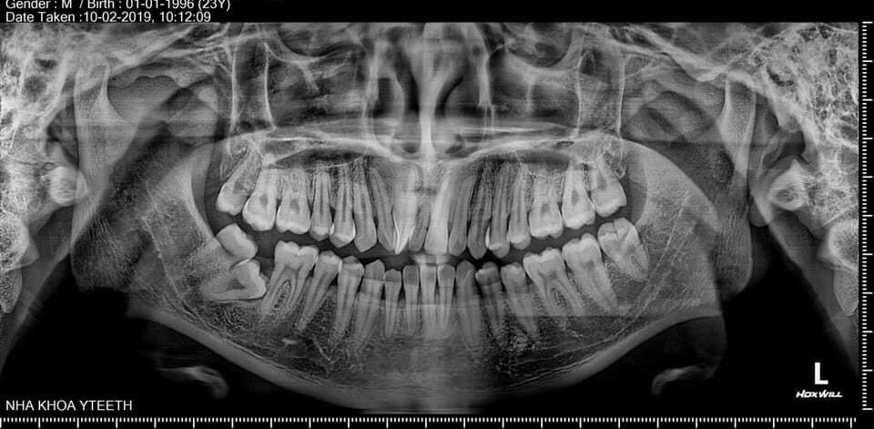 Nhổ răng khôn tại nha khoa Yteeth