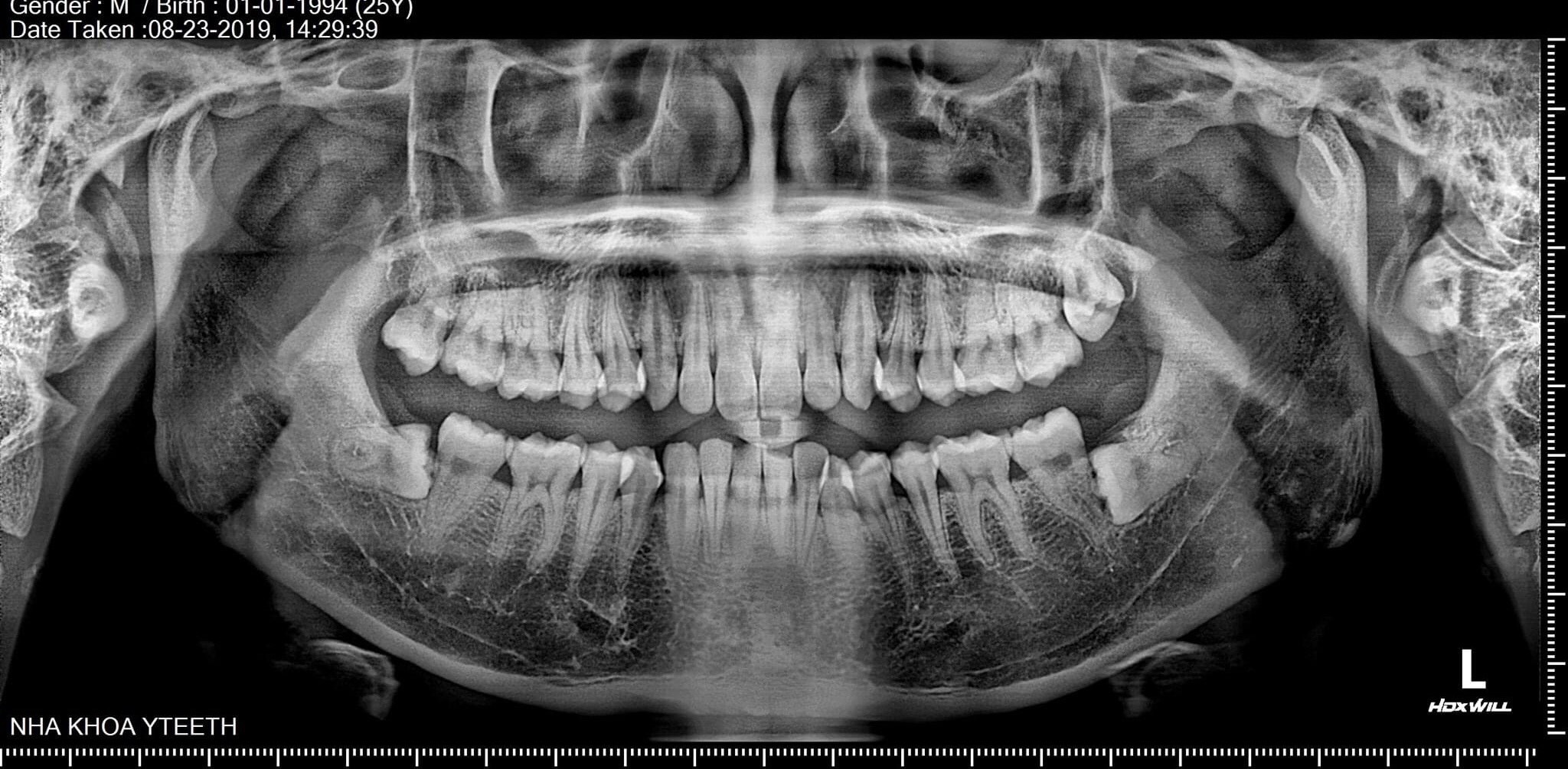 Nhổ răng khôn mọc lệch tại nha khoa Yteeth