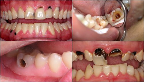 Sâu răng gây hôi miệng - Nha khoa Yteeth