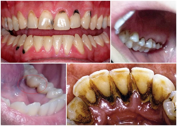 Cao răng viêm lợi gây hôi miệng - Nha khoa Yteeth