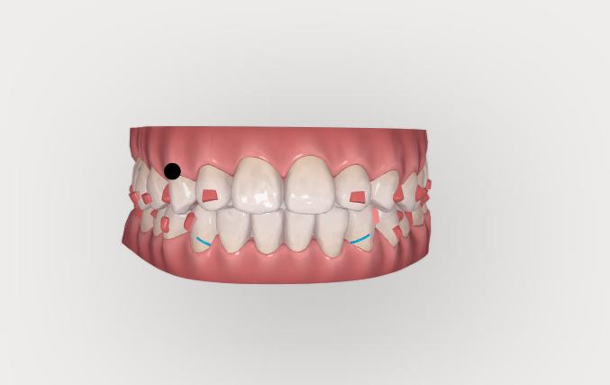 Phần mềm Clincheck mô phỏng kế hoạch di chuyển răng khi niềng Invisalign