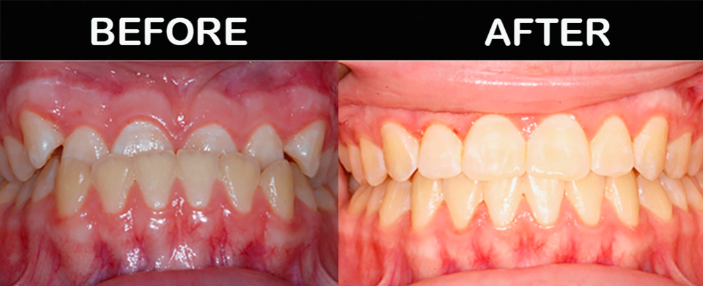 Trước và sau khi niềng răng móm - Bác sĩ Hải Yến Yteeth