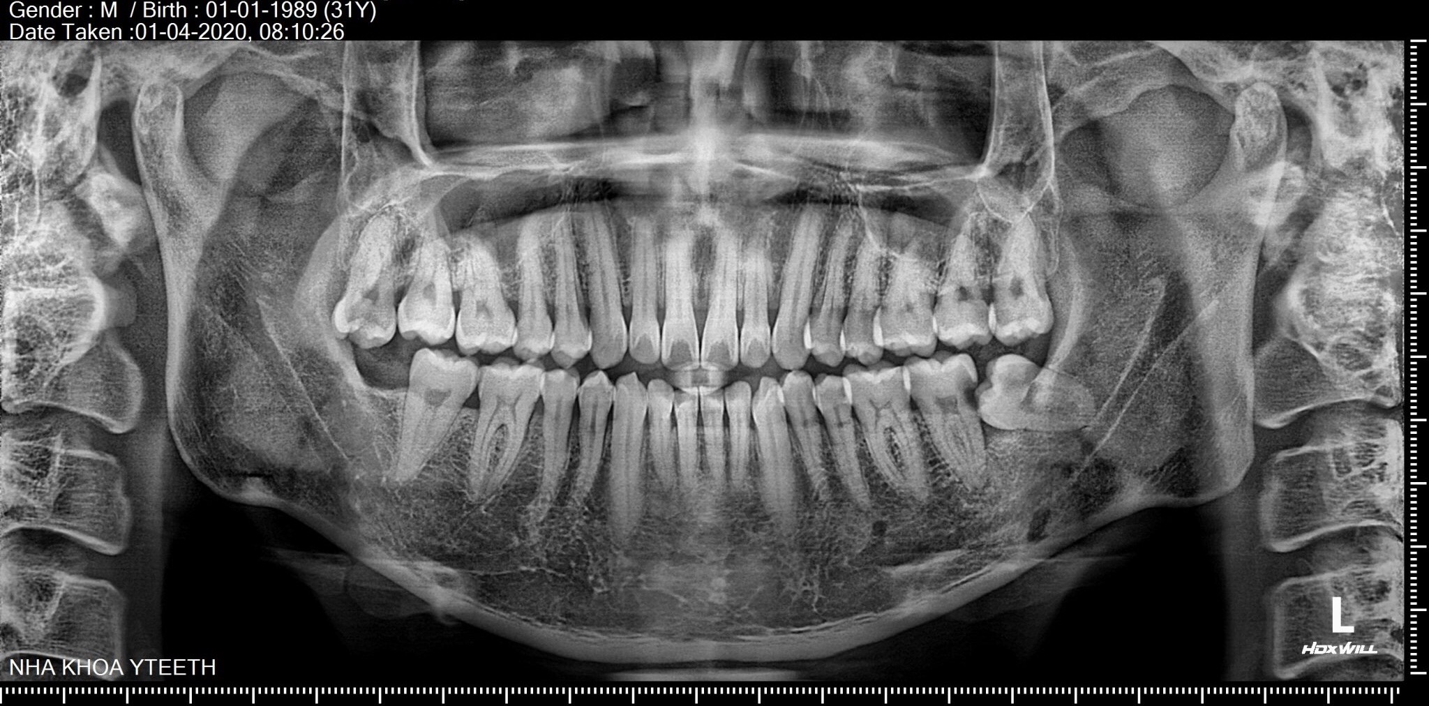 Răng số 8 - Nha khoa Yteeth