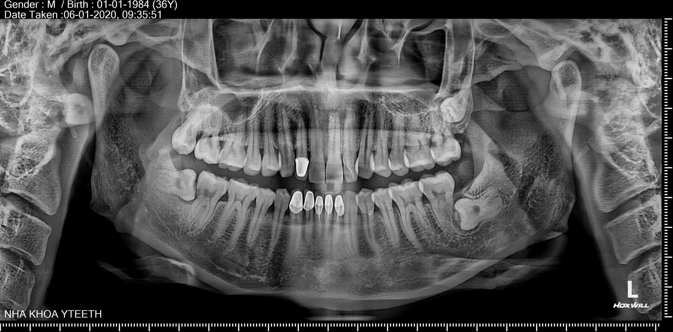 Nhổ răng số 8 tại nha khoa Yteeth