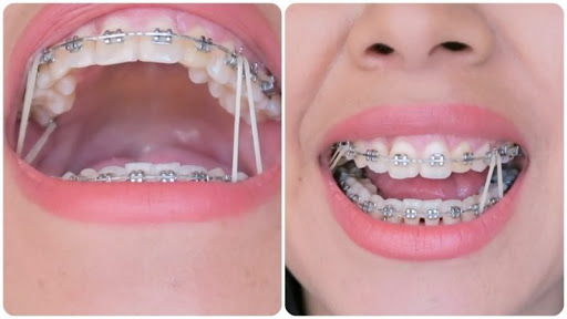 Niềng răng mắc cài kim loại - Dr. Hải Yến Yteeth