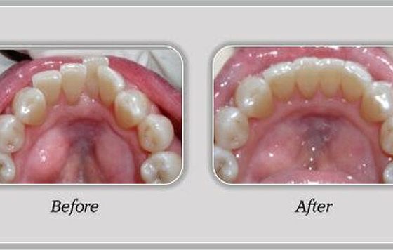 Niềng răng Invisalign - Nha khoa Yteeth