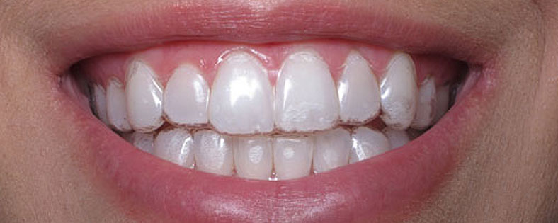 Niềng răng Invisalign - Nha khoa Yteeth