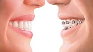 Niềng răng Invisalign – niềng răng mắc cài