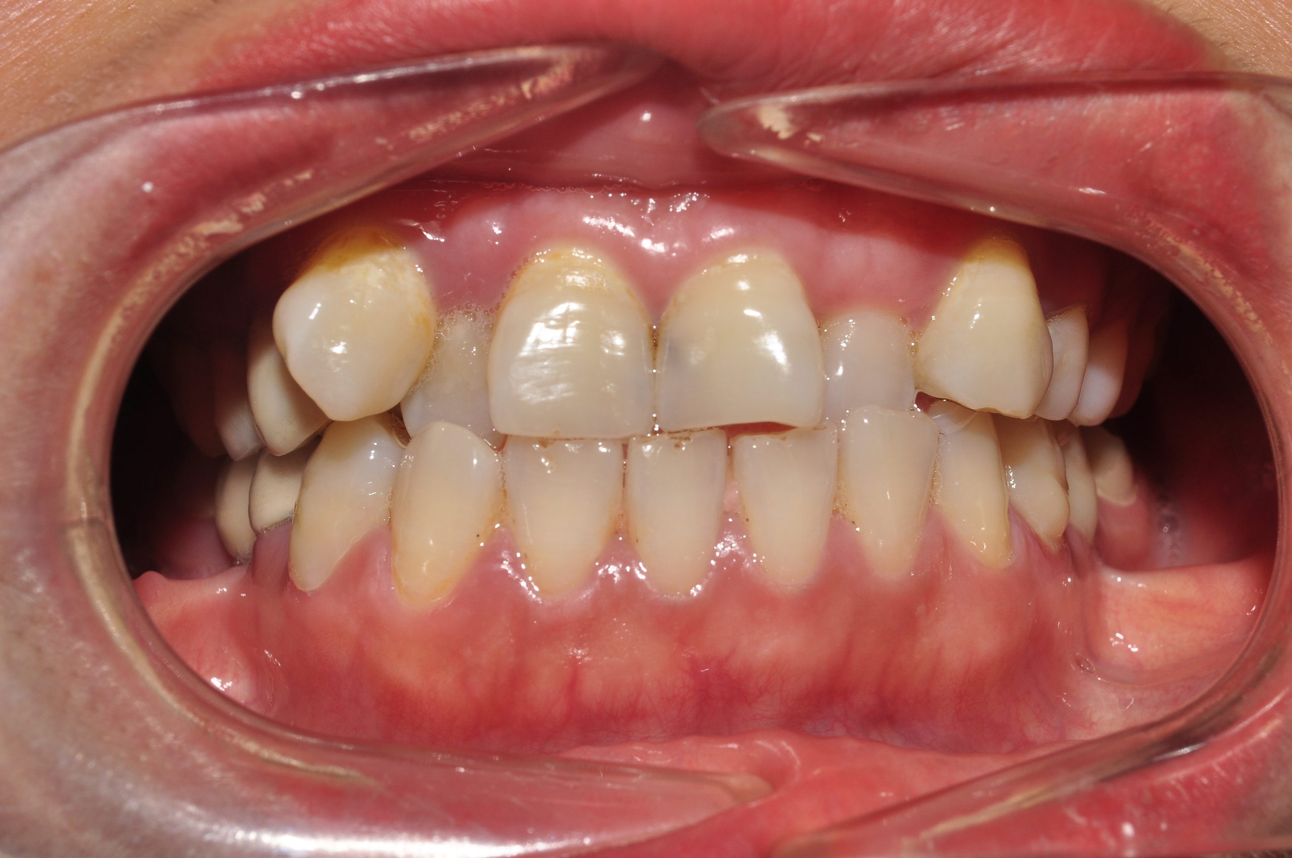 Răng khấp khểnh vệ sinh răng miệng khó dễ dẫn đến sâu răng - Bác sĩ Hải Yến Yteeth