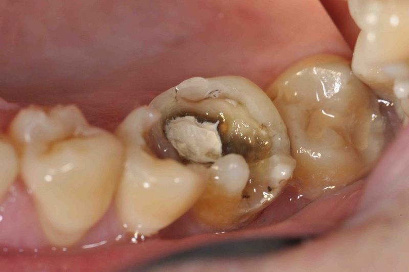 Sâu răng do sự kết hợp của vi khuẩn và mảng bám trên răng - Bác sĩ Hải Yến Yteeth