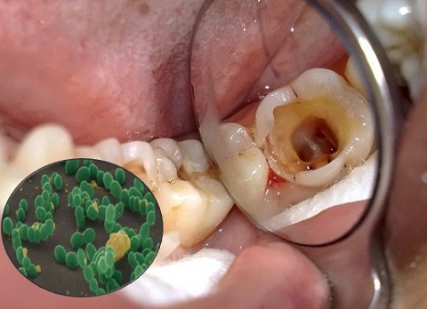 Sâu răng là một quá trình diễn ra trong một thời gian dài - Bác sĩ Hải Yến Yteeth