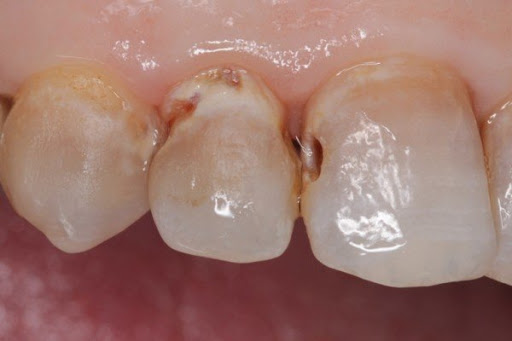Tụt nướu lộ ngà răng dễ bị sâu răng - Bác sĩ Hải Yến Yteeth