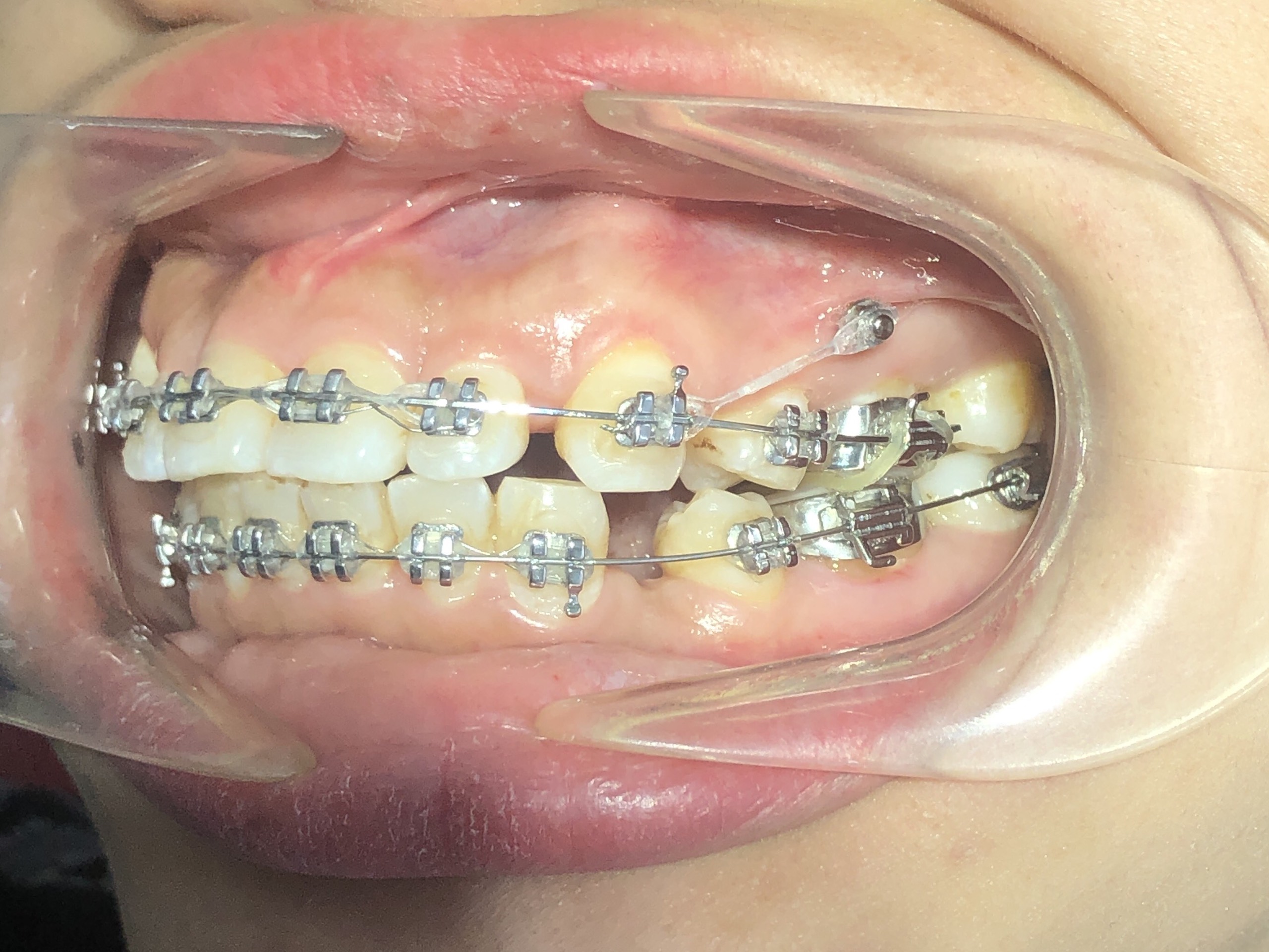 Niềng răng người lớn khả năng nhổ răng rất nhiều - Bác sĩ Hải Yến Yteeth