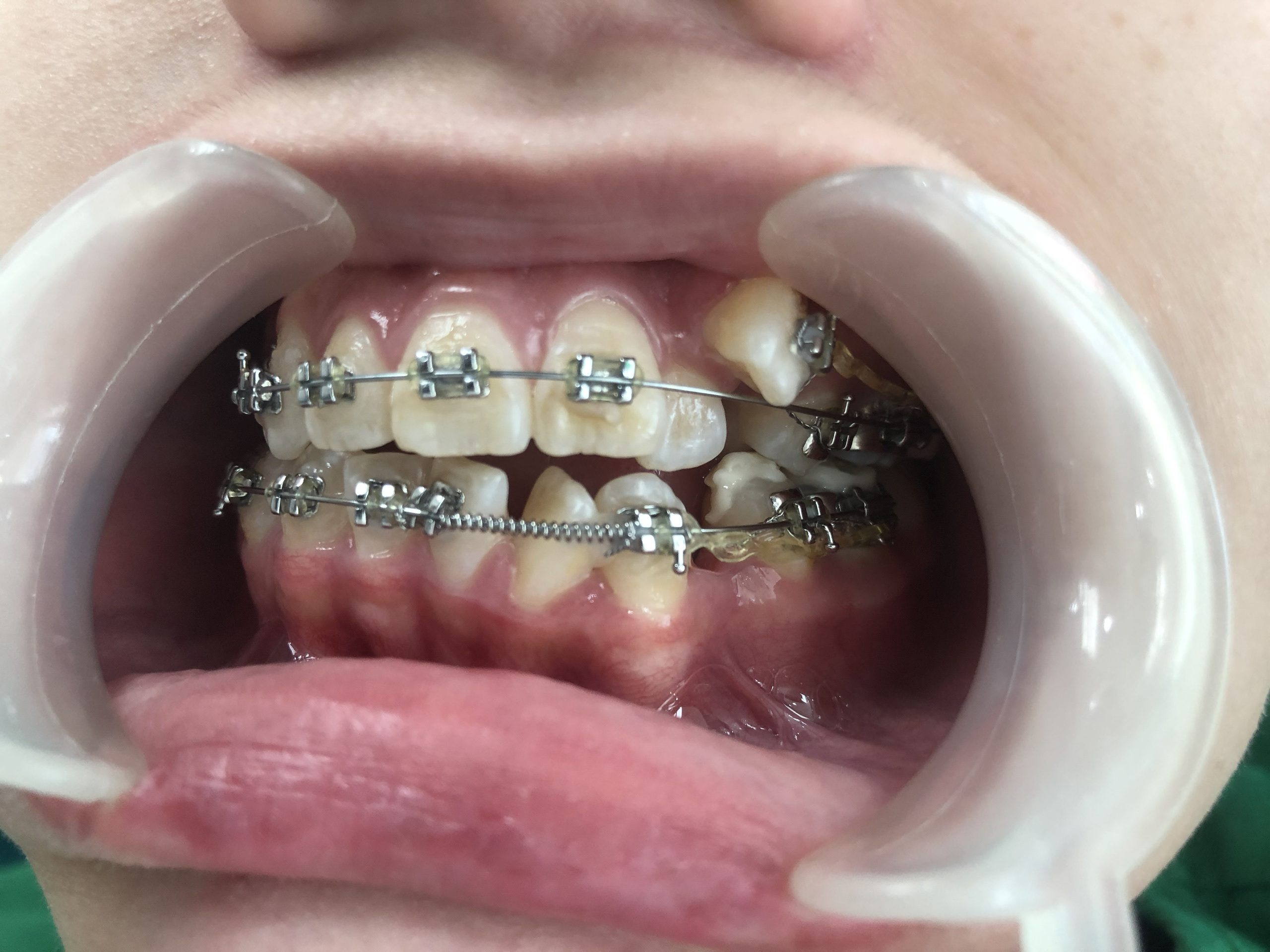 Niềng răng người lớn sẽ khó chịu hơn niềng răng trẻ em - Bác sĩ Hải Yến Yteeth