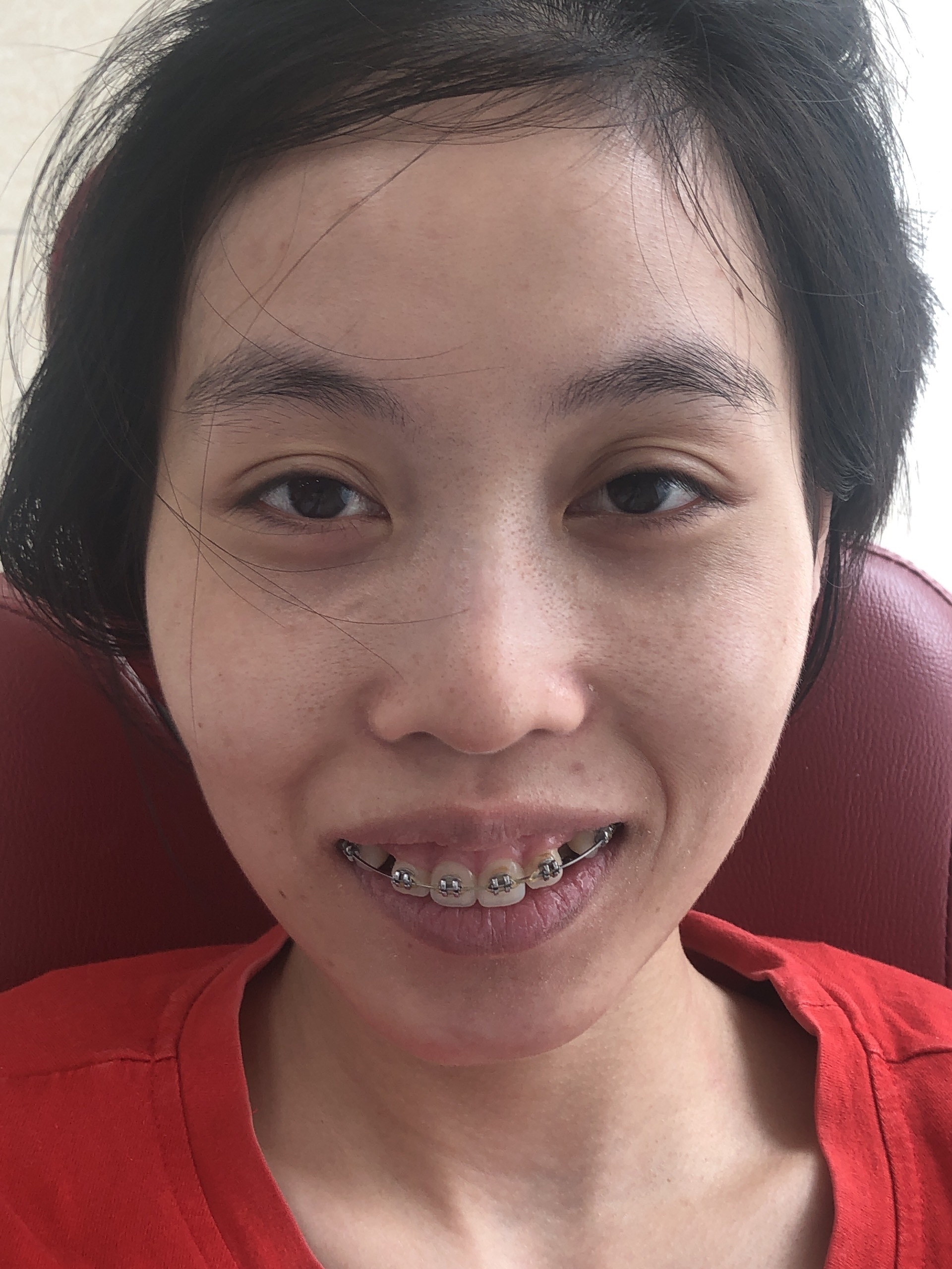 Niềng răng người lớn thời gian lâu hơn - Bác sĩ Hải Yến Yteeth