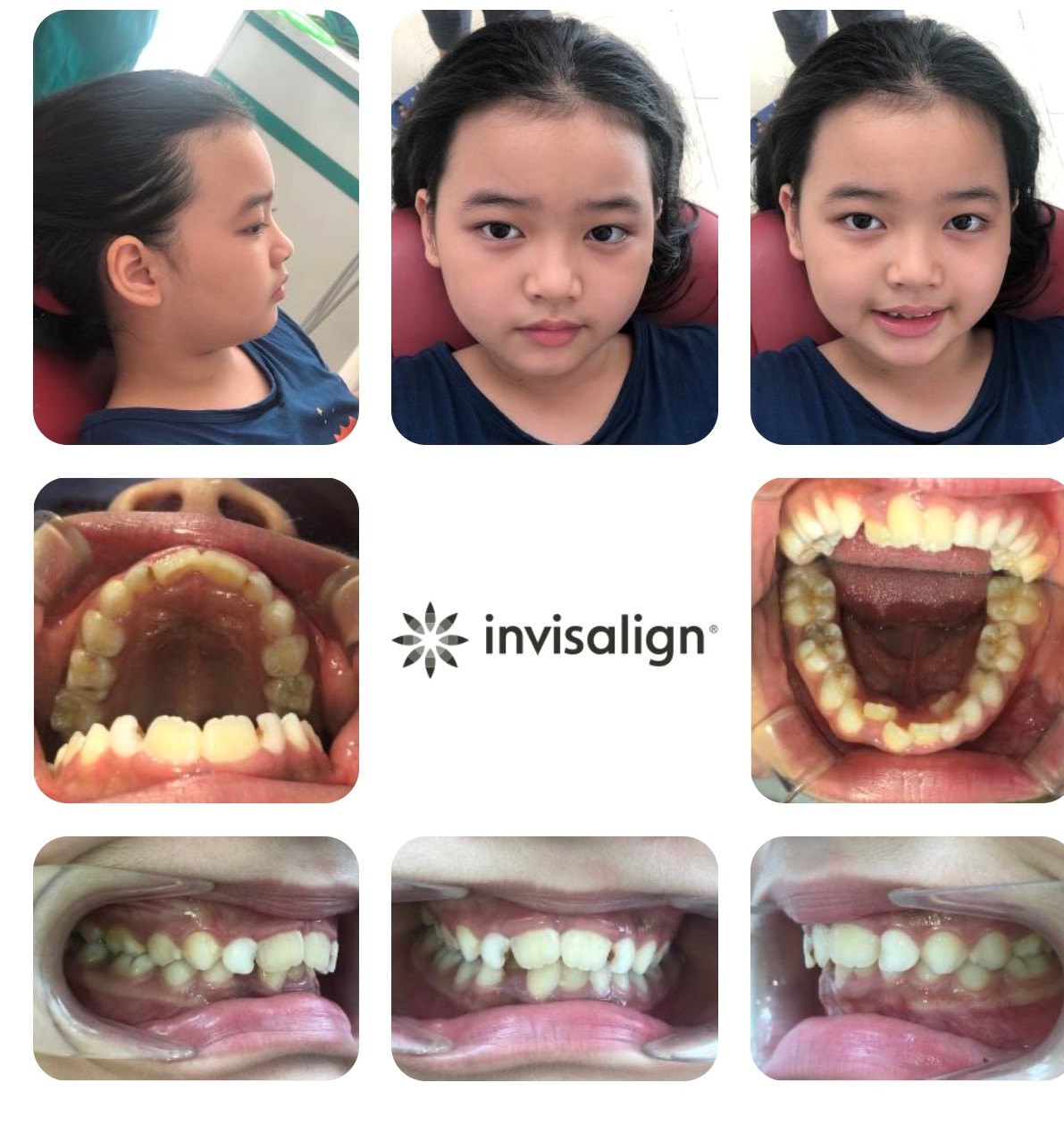 Niềng răng cho trẻ Bác sĩ Hải Yến Yteeth