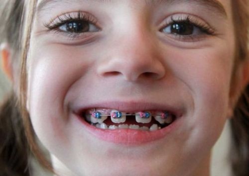 Độ tuổi lý tưởng để niềng răng là trước và trong khi trẻ dậy thì - Nha khoa Yteeth