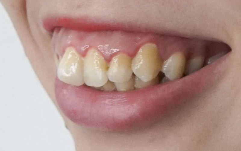 Răng hô (Vẩu) - Nha khoa Yteeth