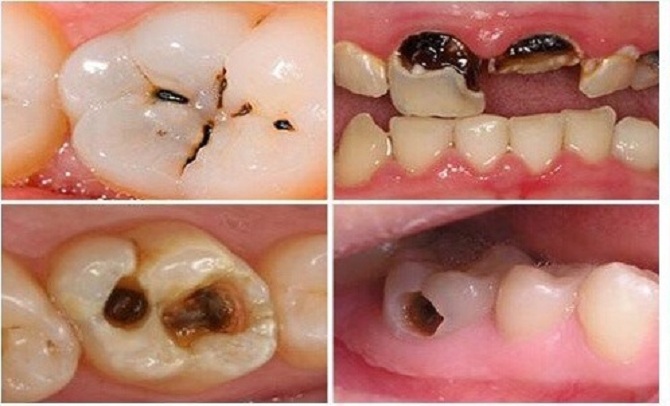 Sâu răng là bệnh rất phổ biến - Nha khoa Yteeth