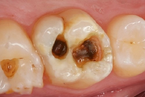 Các lỗ sâu trên răng - Nha khoa Yteeth