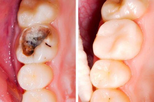 Bọc răng sứ cho răng sâu vỡ to - Nha khoa Yteeth