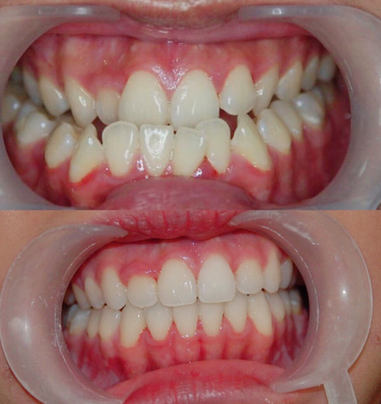 Niềng răng trẻ em hiệu quả tốt hơn người lớn - Bác sĩ Hải Yến Yteeth