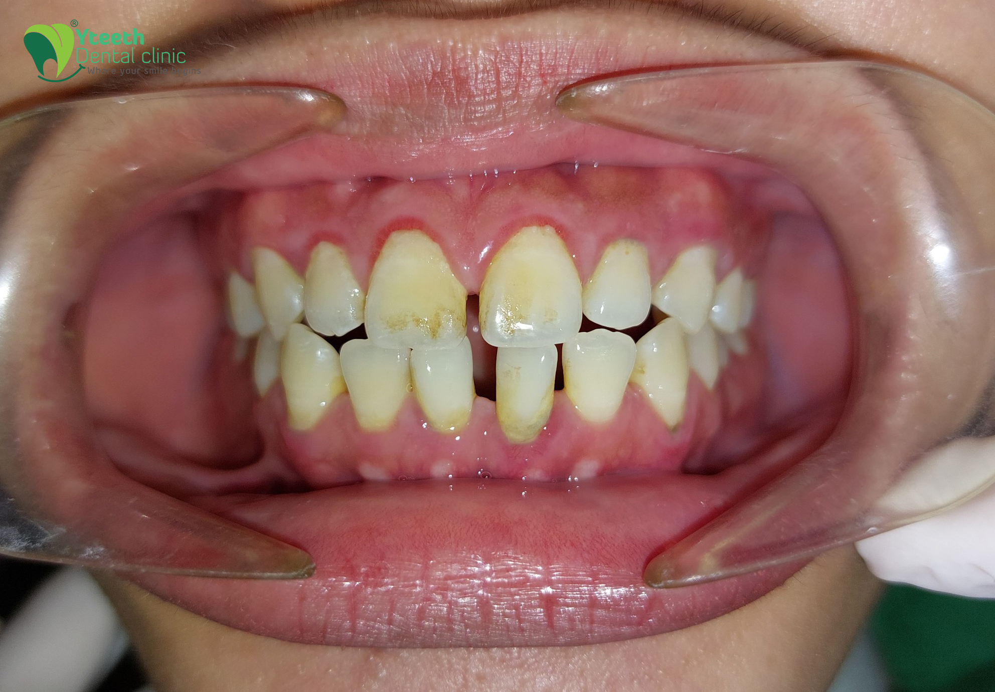  Răng thưa là gì? Những tác hại của hàm răng thưa