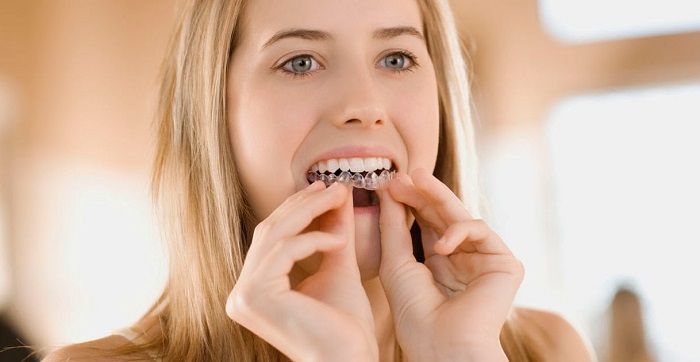 Những cách giảm cảm giác khó chịu khi niềng răng Invisalign 