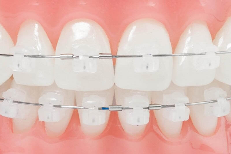 Cách chăm sóc răng khi niềng răng mắc cài sứ