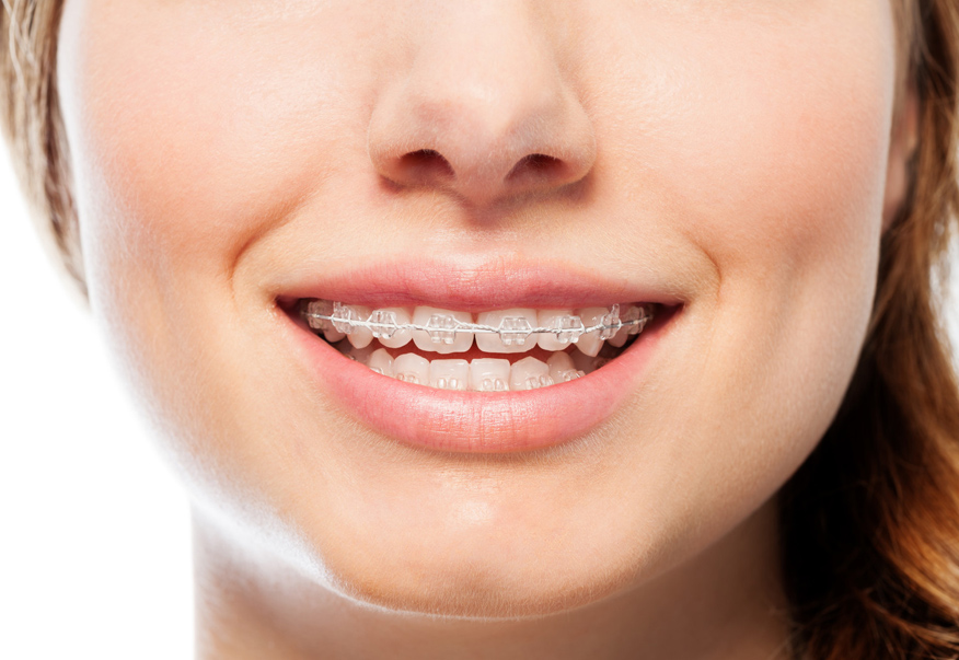 Niềng răng mắc cài sứ thường hiệu quả như thế nào?