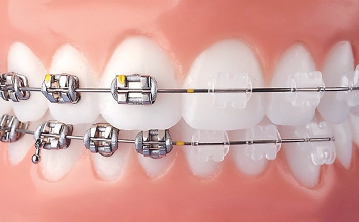Sự khác nhau giữa phương pháp niềng răng mắc cài sứ so với truyền thống