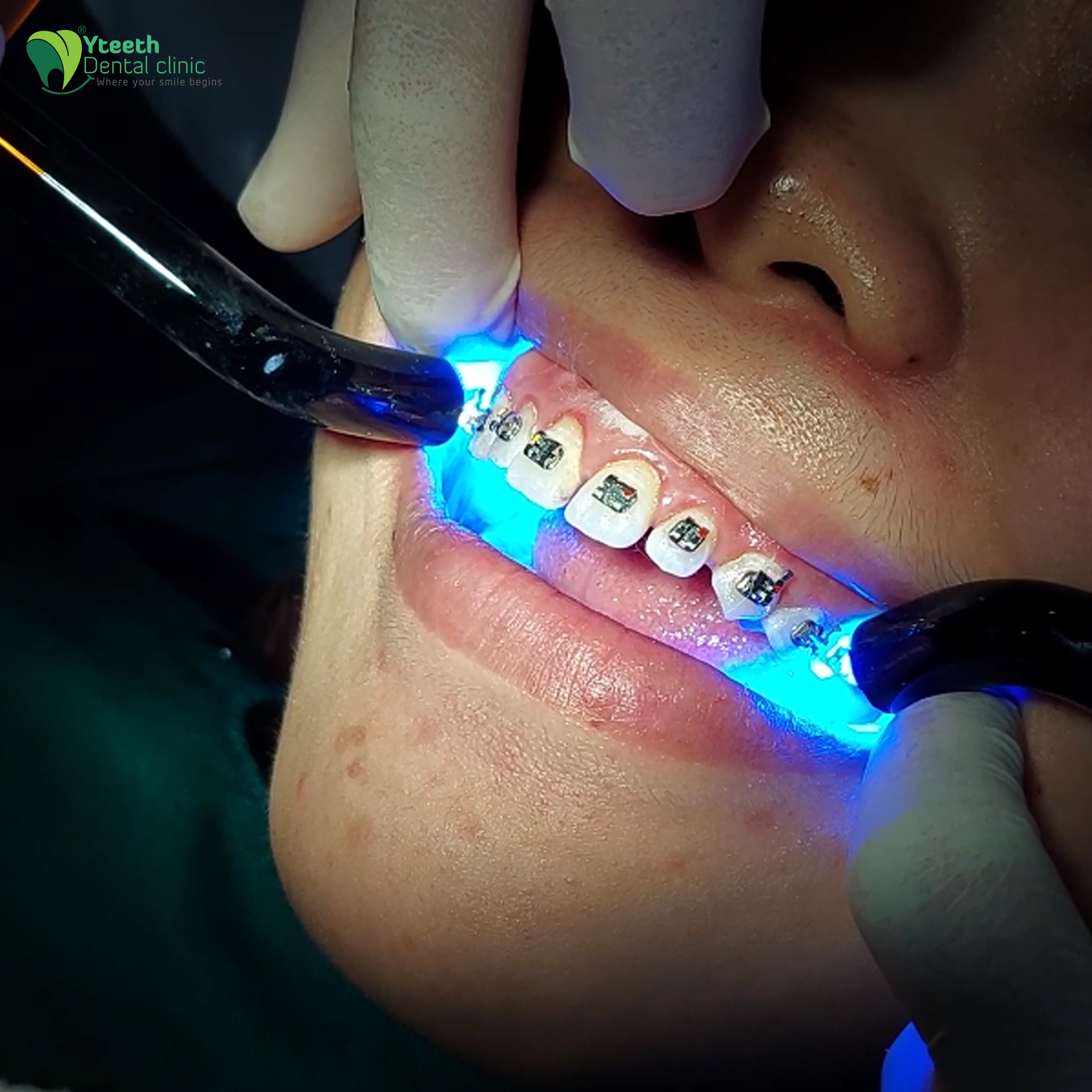 Các bước niềng răng mắc cài kim loại cho răng thưa tại Trung tâm nha khoa Thẩm mỹ Yteeth