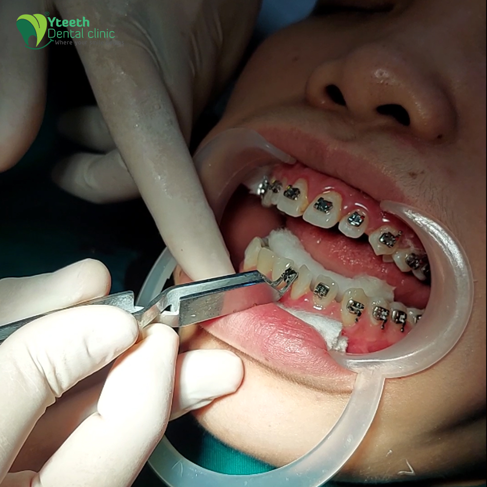 Niềng răng mắc cài kim loại cho răng thưa là gì?